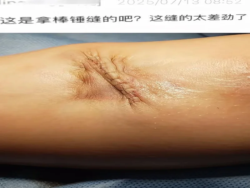 广州豹官方:杨浩眉弓伤口缝合30余针,预计5-7天后拆线